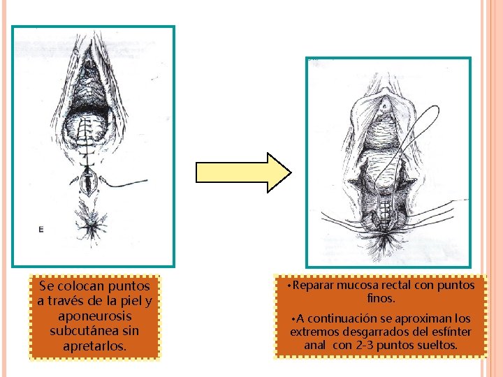 Se colocan puntos a través de la piel y aponeurosis subcutánea sin apretarlos. • Se colocan puntos a través de la piel y aponeurosis subcutánea sin apretarlos. •