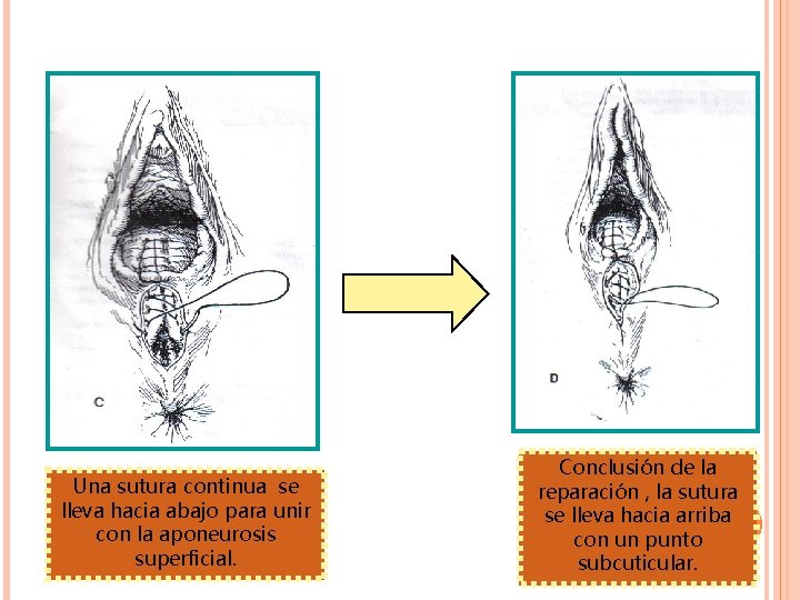 Una sutura continua se lleva hacia abajo para unir con la aponeurosis superficial. Conclusión Una sutura continua se lleva hacia abajo para unir con la aponeurosis superficial. Conclusión