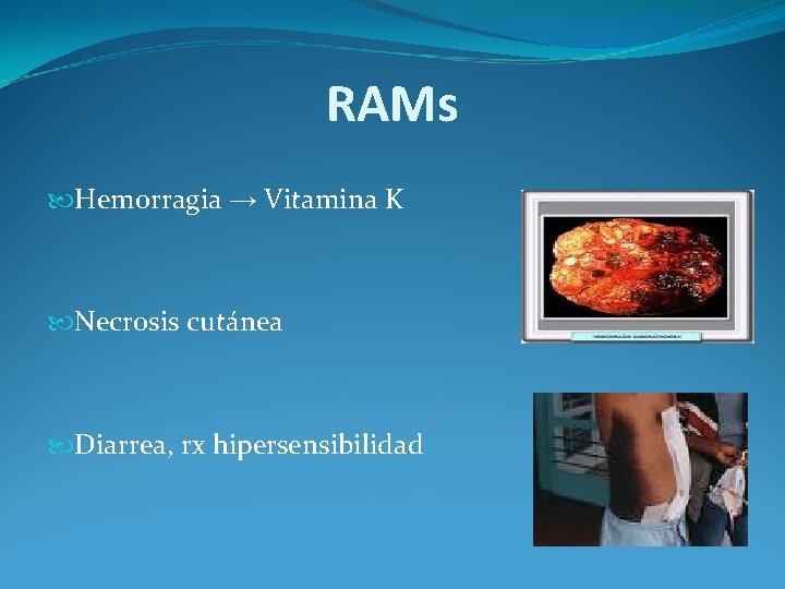 RAMs Hemorragia → Vitamina K Necrosis cutánea Diarrea, rx hipersensibilidad RAMs Hemorragia → Vitamina K Necrosis cutánea Diarrea, rx hipersensibilidad