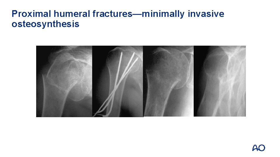 Proximal humeral fractures—minimally invasive osteosynthesis 