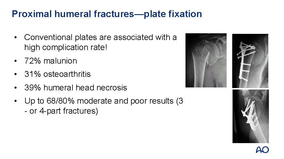 Proximal humeral fractures—plate fixation • Conventional plates are associated with a high complication rate!