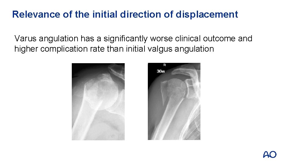 Relevance of the initial direction of displacement Varus angulation has a significantly worse clinical