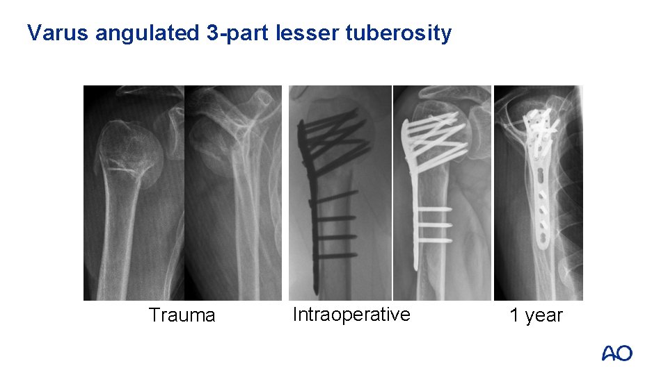 Varus angulated 3 -part lesser tuberosity Trauma Intraoperative 1 year 