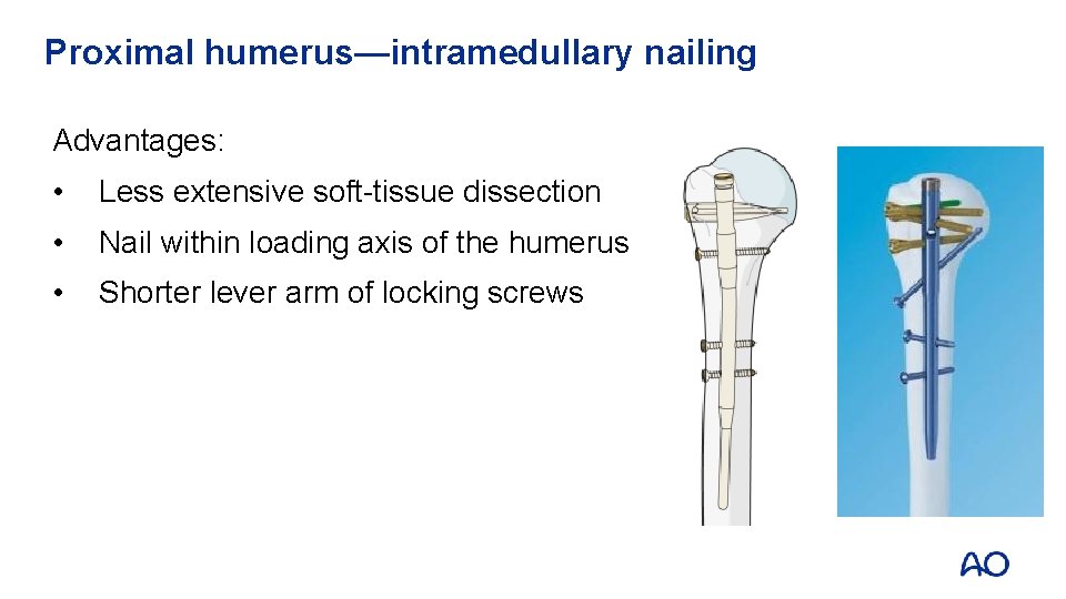Proximal humerus—intramedullary nailing Advantages: • Less extensive soft-tissue dissection • Nail within loading axis
