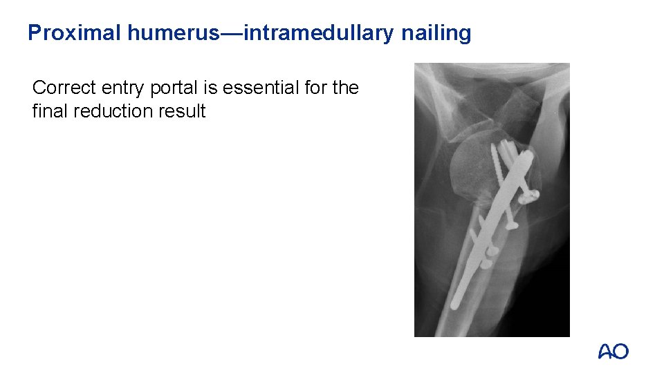 Proximal humerus—intramedullary nailing Correct entry portal is essential for the final reduction result 