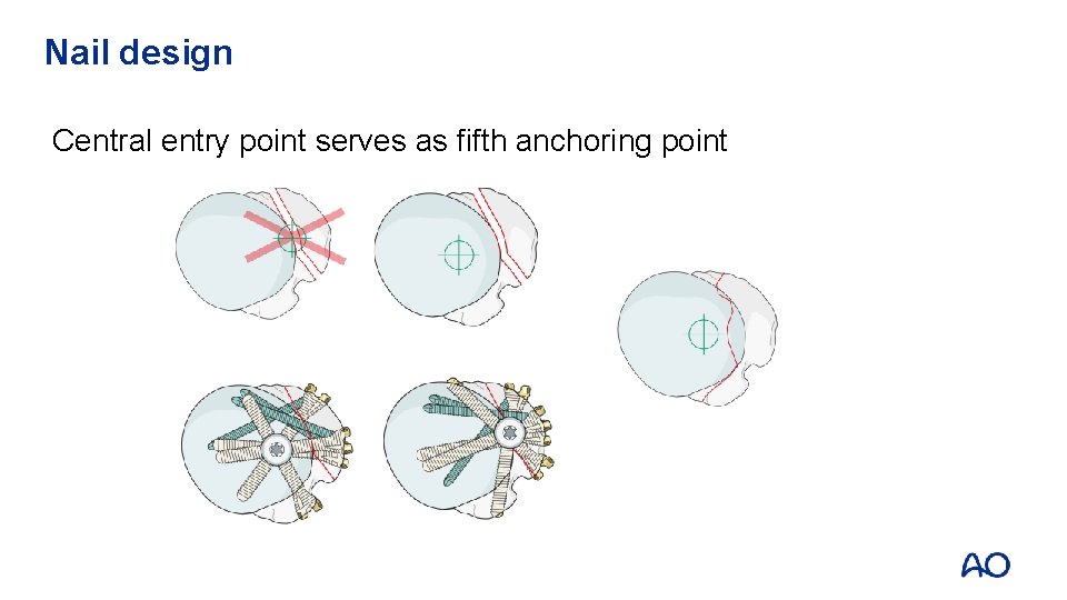 Nail design Central entry point serves as fifth anchoring point 