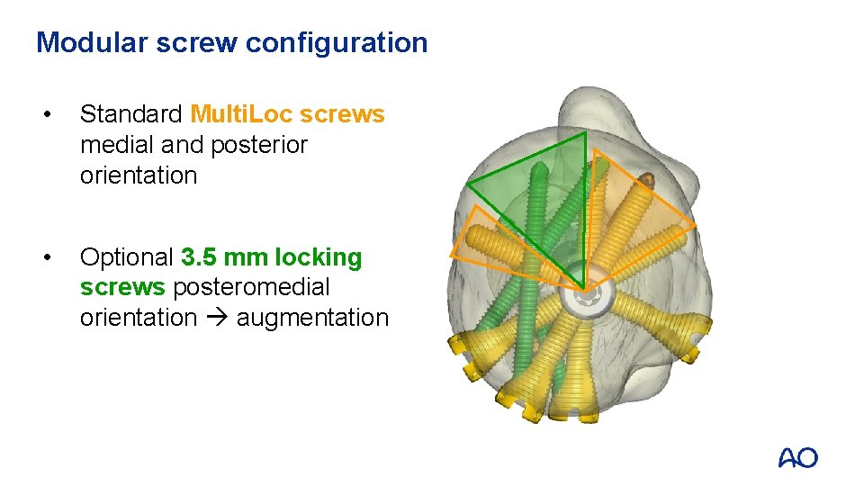 Modular screw configuration • Standard Multi. Loc screws medial and posterior orientation • Optional