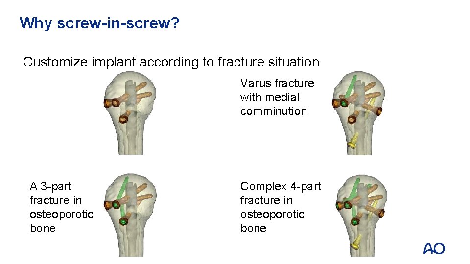 Why screw-in-screw? Customize implant according to fracture situation : 26 patients (22. 6%) A