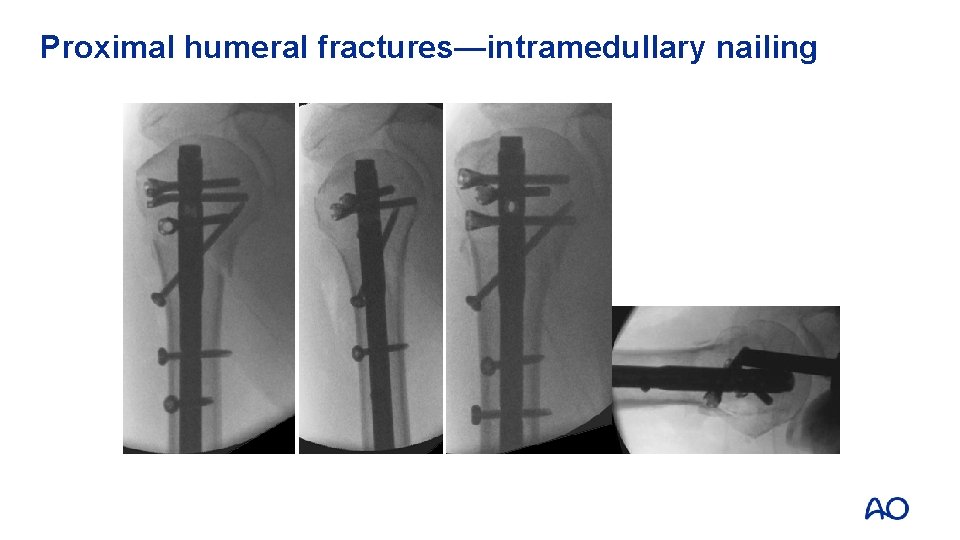 Proximal humeral fractures—intramedullary nailing Synthes Multilock Nail 