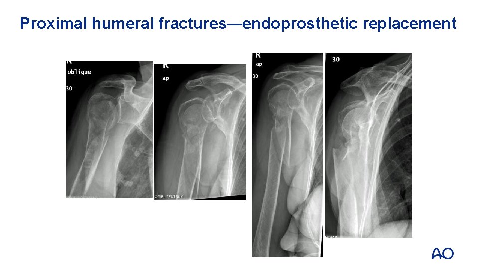 Proximal humeral fractures—endoprosthetic replacement 
