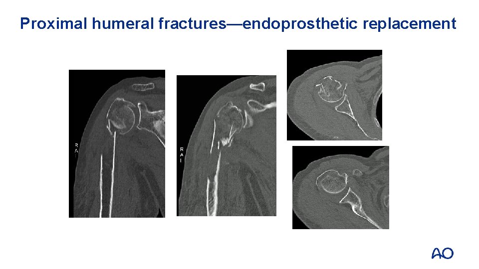 Proximal humeral fractures—endoprosthetic replacement 
