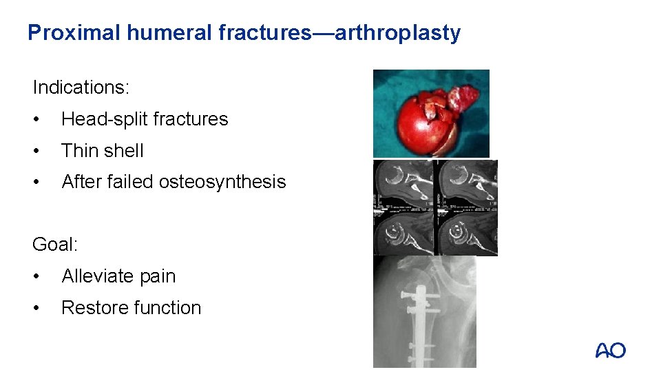 Proximal humeral fractures—arthroplasty Indications: • Head-split fractures • Thin shell • After failed osteosynthesis