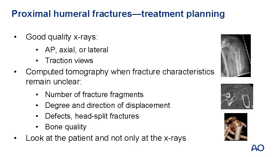 Proximal humeral fractures—treatment planning • Good quality x-rays: • AP, axial, or lateral •