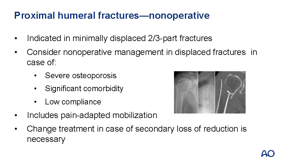 Proximal humeral fractures—nonoperative • Indicated in minimally displaced 2/3 -part fractures • Consider nonoperative