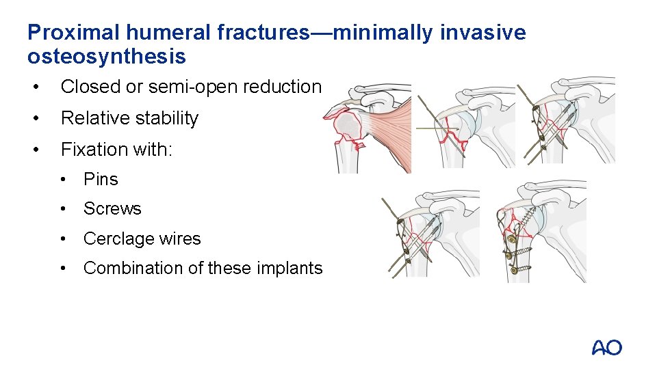 Proximal humeral fractures—minimally invasive osteosynthesis • Closed or semi-open reduction • Relative stability •