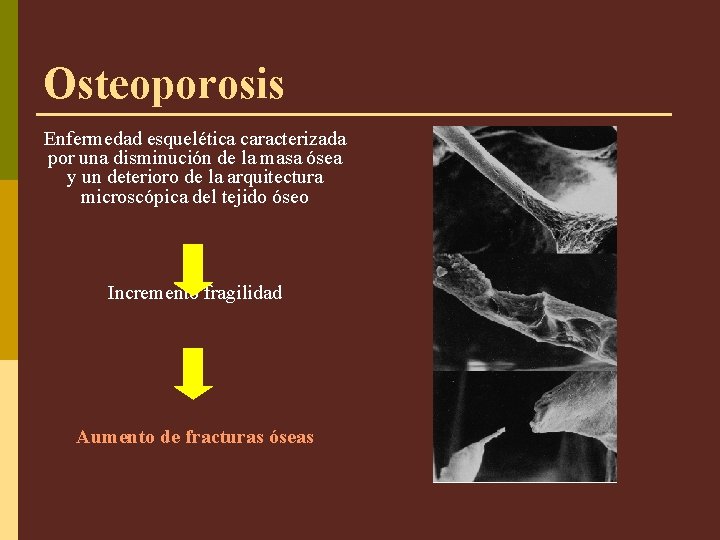 Osteoporosis Enfermedad esquelética caracterizada por una disminución de la masa ósea y un deterioro