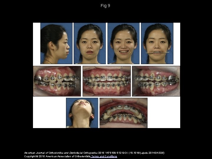 Fig 9 American Journal of Orthodontics and Dentofacial Orthopedics 2015 147 S 109 -S