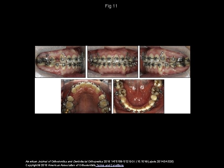 Fig 11 American Journal of Orthodontics and Dentofacial Orthopedics 2015 147 S 109 -S