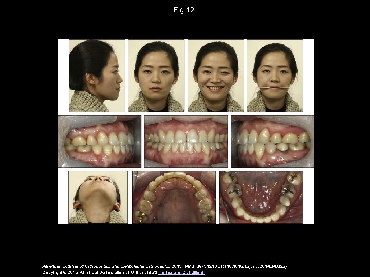 Fig 12 American Journal of Orthodontics and Dentofacial Orthopedics 2015 147 S 109 -S