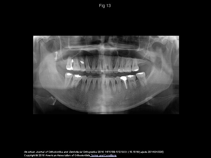 Fig 13 American Journal of Orthodontics and Dentofacial Orthopedics 2015 147 S 109 -S