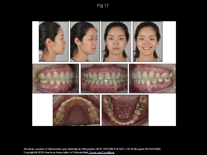 Fig 17 American Journal of Orthodontics and Dentofacial Orthopedics 2015 147 S 109 -S