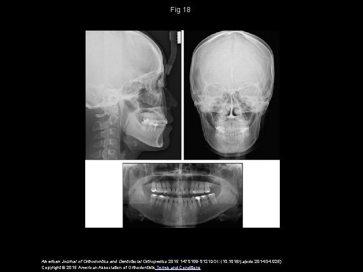 Fig 18 American Journal of Orthodontics and Dentofacial Orthopedics 2015 147 S 109 -S