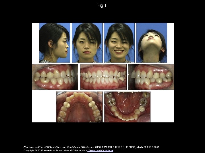 Fig 1 American Journal of Orthodontics and Dentofacial Orthopedics 2015 147 S 109 -S