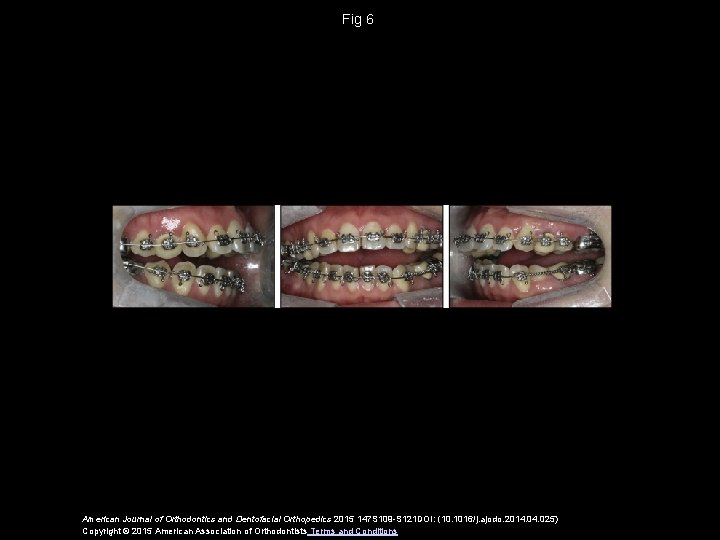 Fig 6 American Journal of Orthodontics and Dentofacial Orthopedics 2015 147 S 109 -S