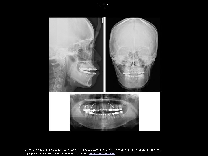 Fig 7 American Journal of Orthodontics and Dentofacial Orthopedics 2015 147 S 109 -S