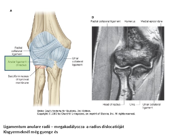 Ligamentum anulare radii – megakadályozza a radius dislocatióját Kisgyermeknél még gyenge és Ligamentum anulare radii – megakadályozza a radius dislocatióját Kisgyermeknél még gyenge és