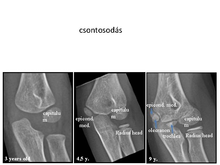 CRITOE csontosodás capitulu m epicond. med. capitulu m Radius head 3 years old 4, CRITOE csontosodás capitulu m epicond. med. capitulu m Radius head 3 years old 4,