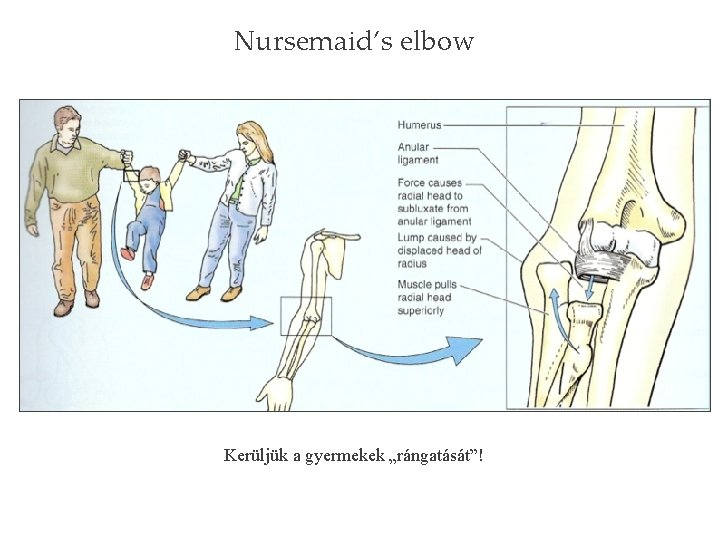 Nursemaid’s elbow Kerüljük a gyermekek „rángatását”! Nursemaid’s elbow Kerüljük a gyermekek „rángatását”!