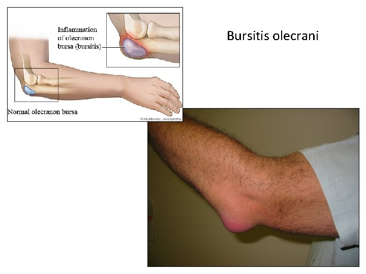 Bursitis olecrani Bursitis olecrani