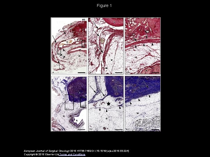 Figure 1 European Journal of Surgical Oncology 2015 41738 -745 DOI: (10. 1016/j. ejso.