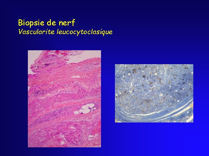 Biopsie de nerf Vascularite leucocytoclasique 