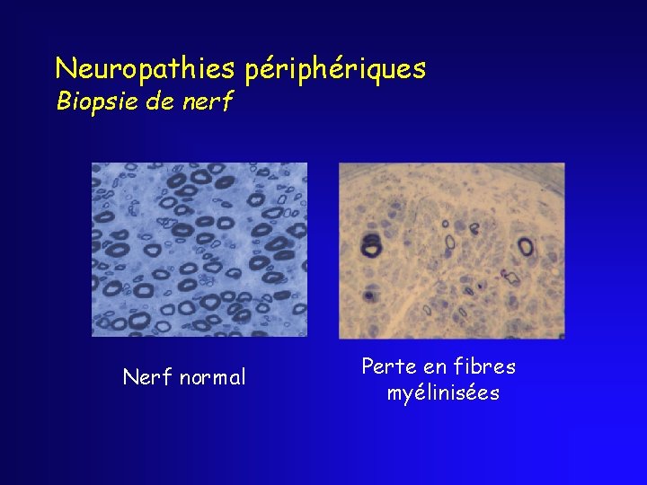 Neuropathies périphériques Biopsie de nerf Nerf normal Perte en fibres myélinisées 