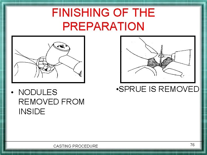 FINISHING OF THE PREPARATION • NODULES REMOVED FROM INSIDE CASTING PROCEDURE • SPRUE IS