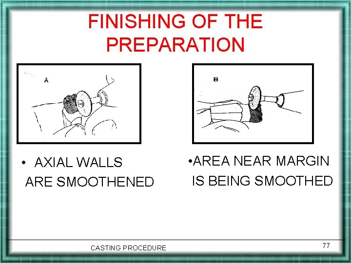 FINISHING OF THE PREPARATION • AXIAL WALLS ARE SMOOTHENED CASTING PROCEDURE • AREA NEAR