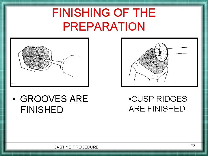 FINISHING OF THE PREPARATION • GROOVES ARE FINISHED CASTING PROCEDURE • CUSP RIDGES ARE