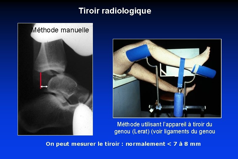Tiroir radiologique Méthode manuelle Méthode utilisant l’appareil à tiroir du genou (Lerat) (voir ligaments Tiroir radiologique Méthode manuelle Méthode utilisant l’appareil à tiroir du genou (Lerat) (voir ligaments