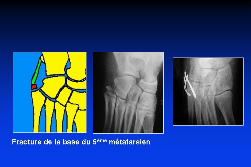 Fracture de la base du 5ème métatarsien Fracture de la base du 5ème métatarsien