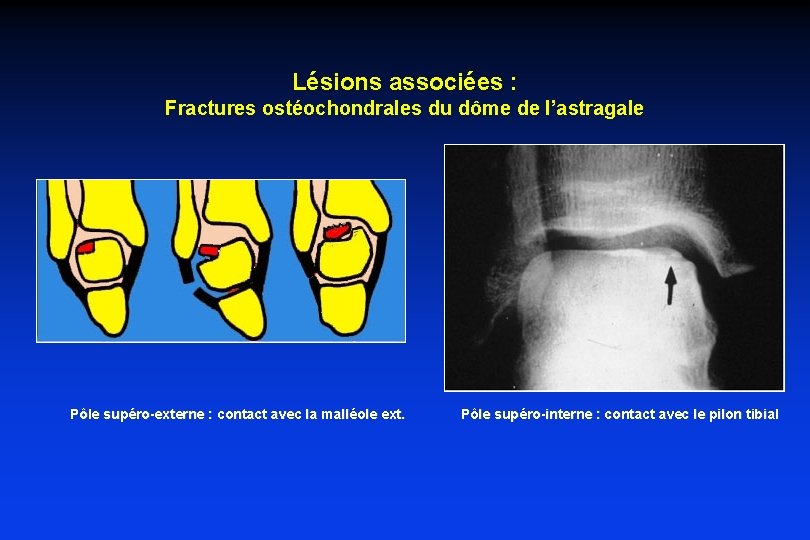 Lésions associées : Fractures ostéochondrales du dôme de l’astragale Pôle supéro-externe : contact avec Lésions associées : Fractures ostéochondrales du dôme de l’astragale Pôle supéro-externe : contact avec