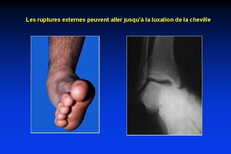 Les ruptures externes peuvent aller jusqu’à la luxation de la cheville Les ruptures externes peuvent aller jusqu’à la luxation de la cheville