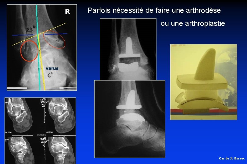 Parfois nécessité de faire une arthrodèse ou une arthroplastie Cas de JL Bessec Parfois nécessité de faire une arthrodèse ou une arthroplastie Cas de JL Bessec
