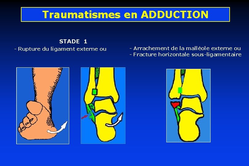 Traumatismes en ADDUCTION STADE 1 - Rupture du ligament externe ou - Arrachement de Traumatismes en ADDUCTION STADE 1 - Rupture du ligament externe ou - Arrachement de
