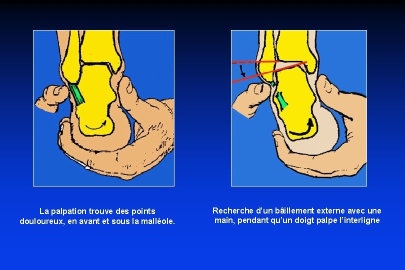 La palpation trouve des points douloureux, en avant et sous la malléole. Recherche d’un La palpation trouve des points douloureux, en avant et sous la malléole. Recherche d’un