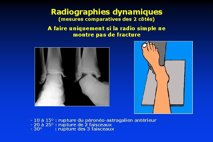 Radiographies dynamiques (mesures comparatives des 2 côtés) A faire uniquement si la radio simple Radiographies dynamiques (mesures comparatives des 2 côtés) A faire uniquement si la radio simple