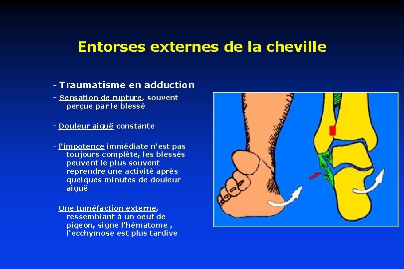 Entorses externes de la cheville - Traumatisme en adduction - Sensation de rupture, souvent Entorses externes de la cheville - Traumatisme en adduction - Sensation de rupture, souvent