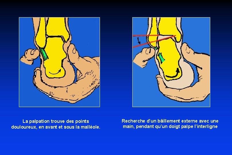 La palpation trouve des points douloureux, en avant et sous la malléole. Recherche d’un La palpation trouve des points douloureux, en avant et sous la malléole. Recherche d’un