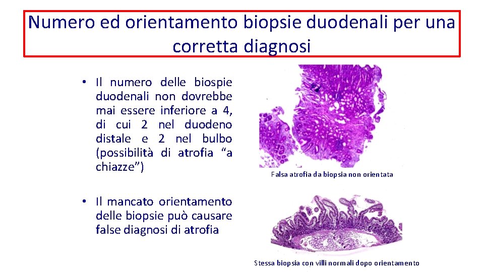 Numero ed orientamento biopsie duodenali per una corretta diagnosi • Il numero delle biospie